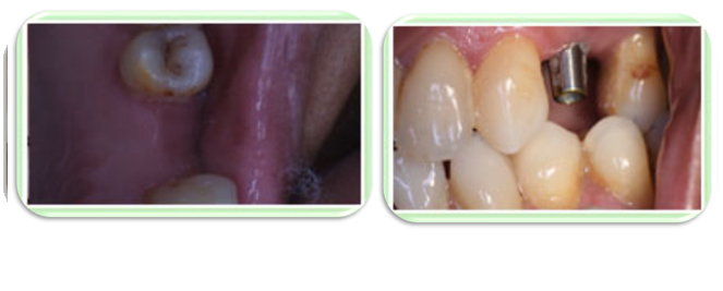 dental-implant-in