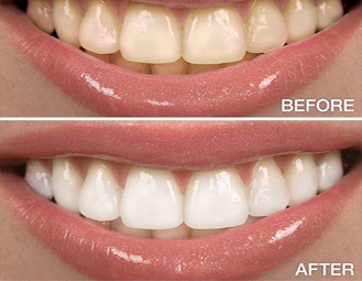 teethwhiten1